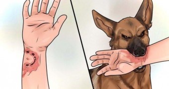 Что делать если укусила собака ?